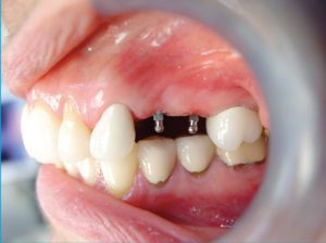 maryland-mini-implants-2