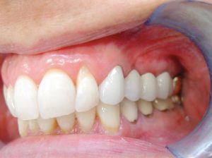 maryland-mini-implants-3